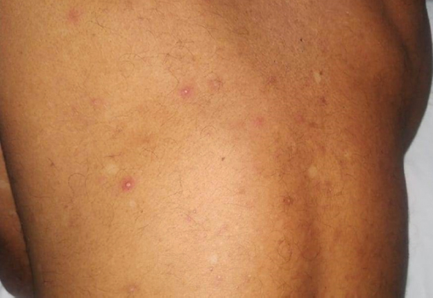 Papulopustular skin lesions over trunk at the time of pyrexial illness.